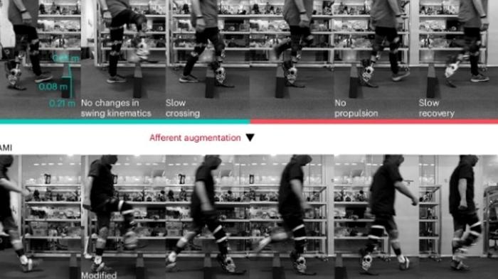 Protesi di gamba controllata dal sistema nervoso: camminare in modo naturale e veloce